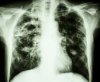 x-ray-of-pulmonary-fibrosis.jpg