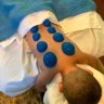 Cupping Therapy/Massage