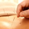 Student Acupuncture Treatments