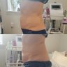 Reduce your belly, tighten your doublechin with body contouring!